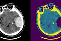 ИИ для диагностики черепно-мозговых травм разрабатывают в Нижнем Новгороде